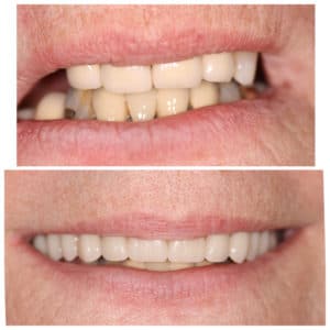 Before and after of a Streitz Dental Arts patient — Denture