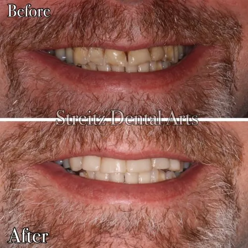 Before and after of a Streitz Dental Arts patient — One-Appointment Composite Bonding