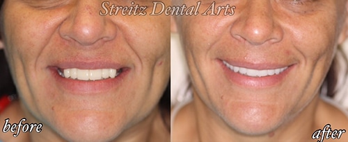 Before and after of a Streitz Dental Arts patient — Before & After