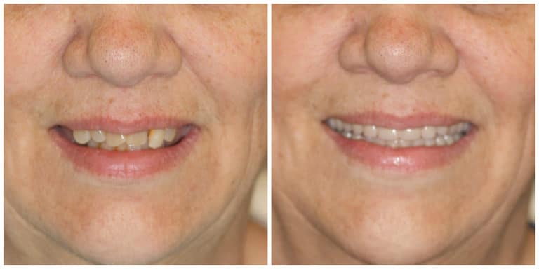 Before and after of a Streitz Dental Arts patient — Natural-Looking Denture