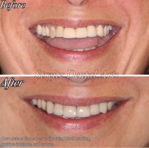 Before and after of a Streitz Dental Arts patient — Smile Makeover — Multiple Implants, Crowns & Bone Grafting