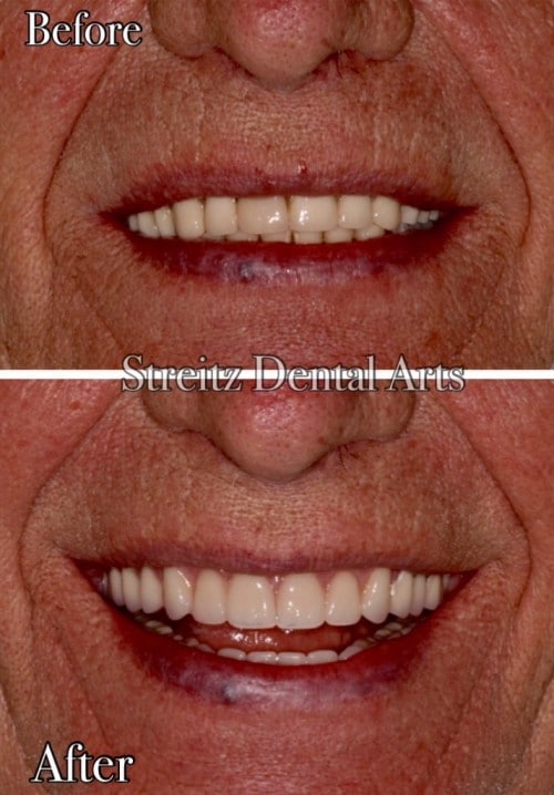 Before and after of a Streitz Dental Arts patient — Brighter, Whiter Smile