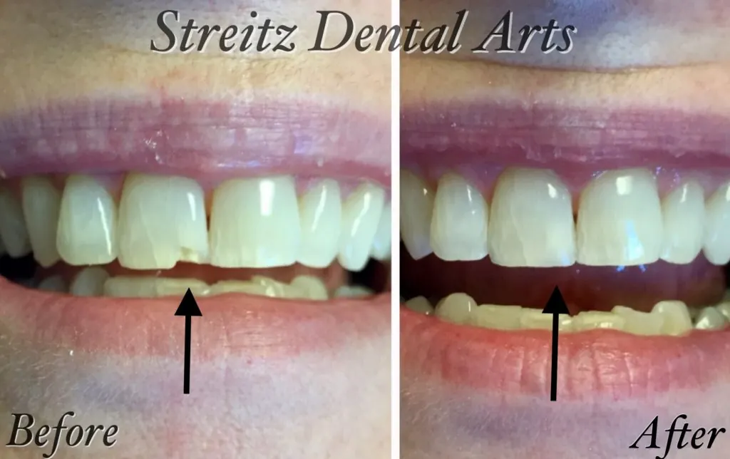 Before and after of a Streitz Dental Arts patient — Chipped Front Tooth — Composite Bonding