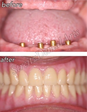 Before and after of a Streitz Dental Arts patient — Denture Implants