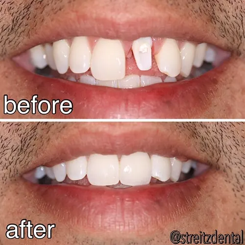 Before and after of a Streitz Dental Arts patient — Single Dental Implant