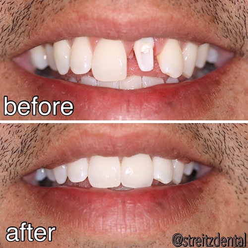 rotten teeth before and after