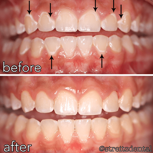 rotten teeth before and after