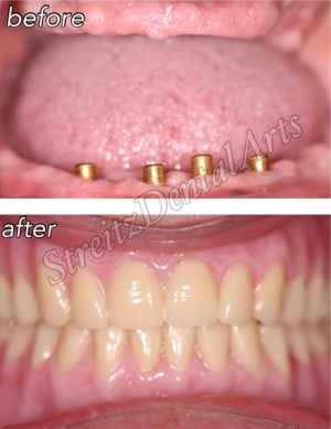 Dental Implants