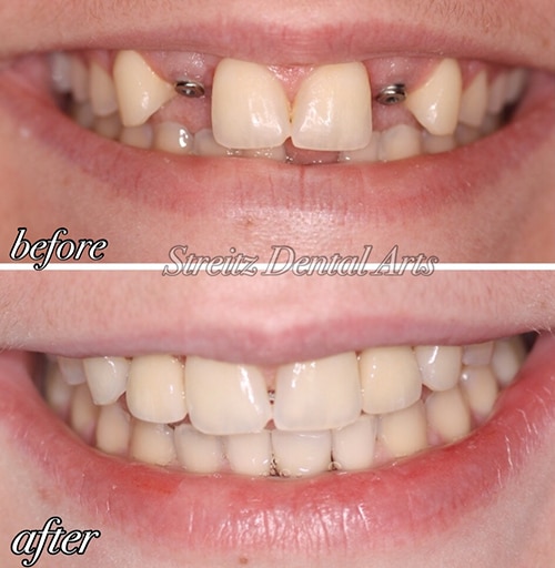 Dental Implants