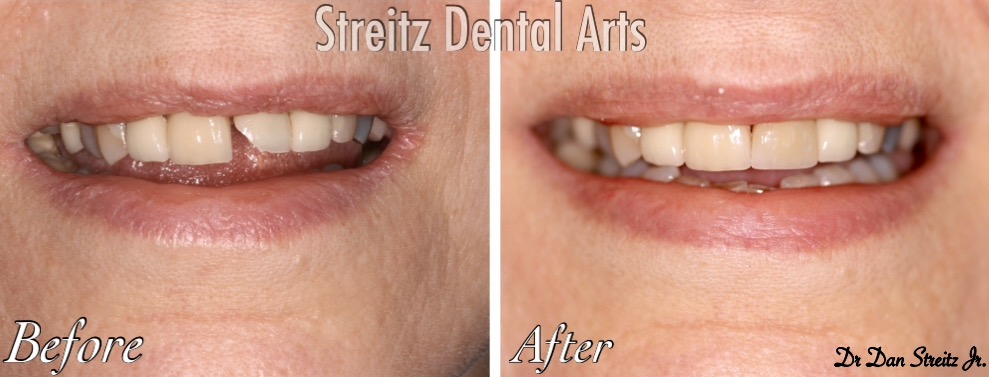 Before after single anterior Before after single anterior