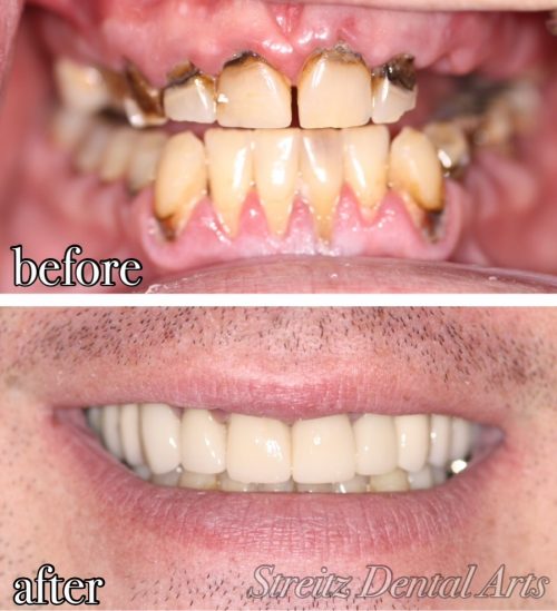 Before and After Photos of Dental Implants and Cosmetic Dentistry