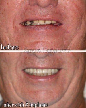 Denture Implants