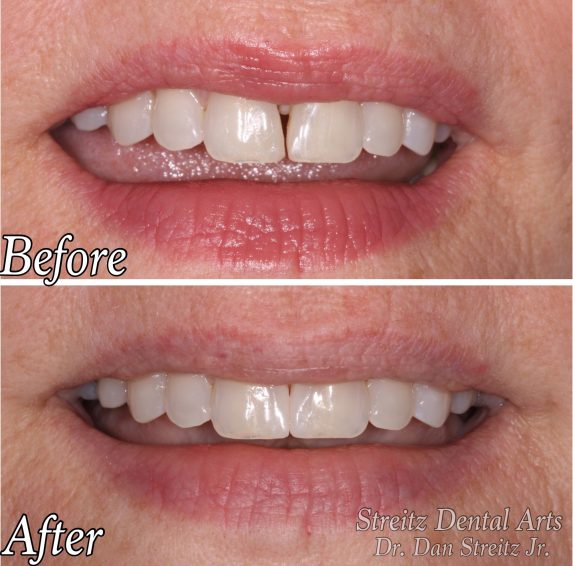 dental implants front teeth