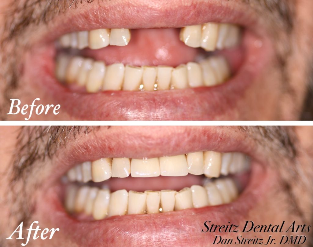 hypodontia before and after