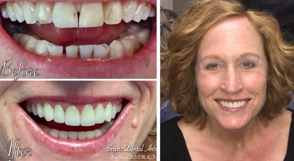 extreme makeover before and after teeth