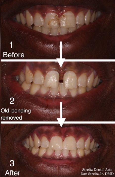 hypodontia before and after