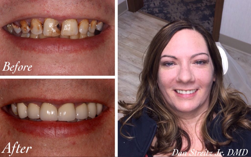 smile makeover before and after