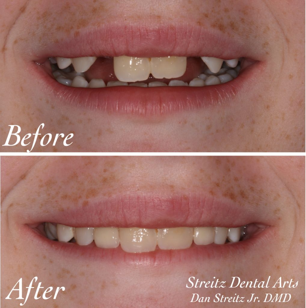 tooth implant before and after