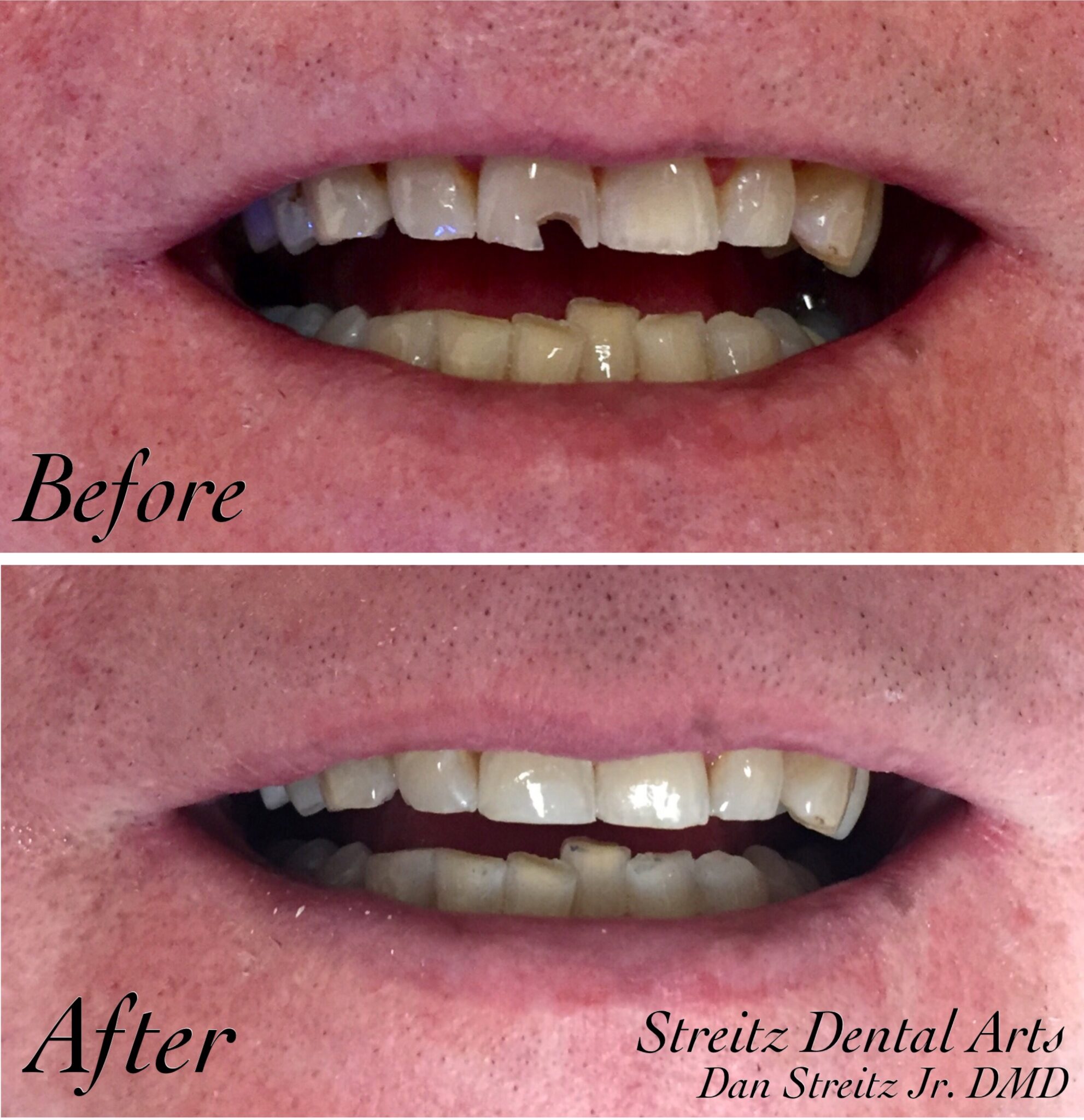Before And After Photos Of Dental Implants And Cosmetic Dentistry 