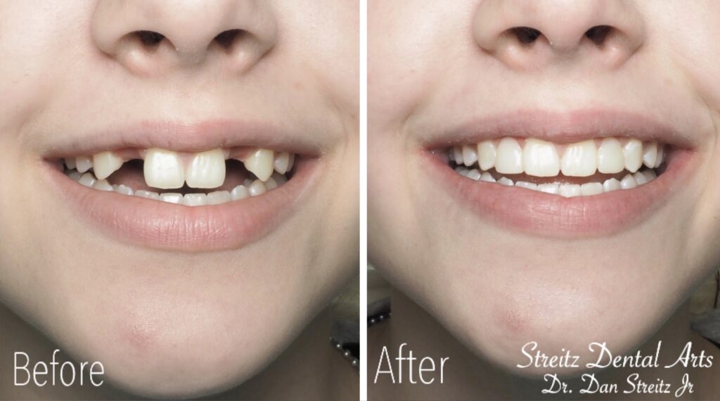 Before and After Photos of Dental Implants and Cosmetic Dentistry