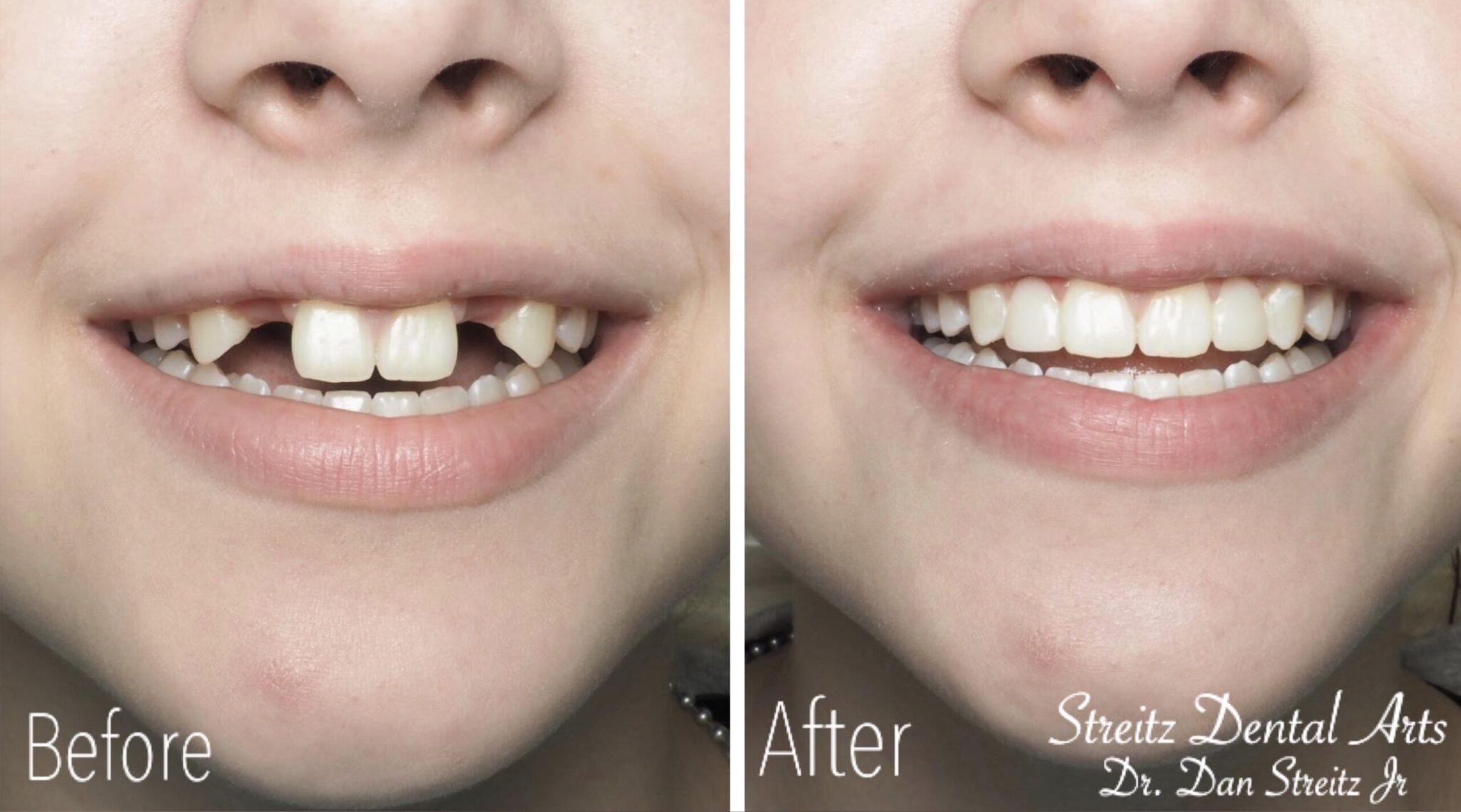 Before And After Photos Of Dental Implants And Cosmetic Dentistry